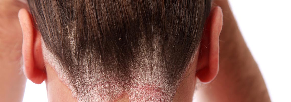 HOW TO TRANSITION WITH YOUR SCALP CONDITION